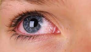 तीर्थक्षेत्र आळंदी परिसरात मुलांमध्ये डोळ्यांची साथ...